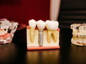 Comment fonctionne une surcomplémentaire santé dentaire ?